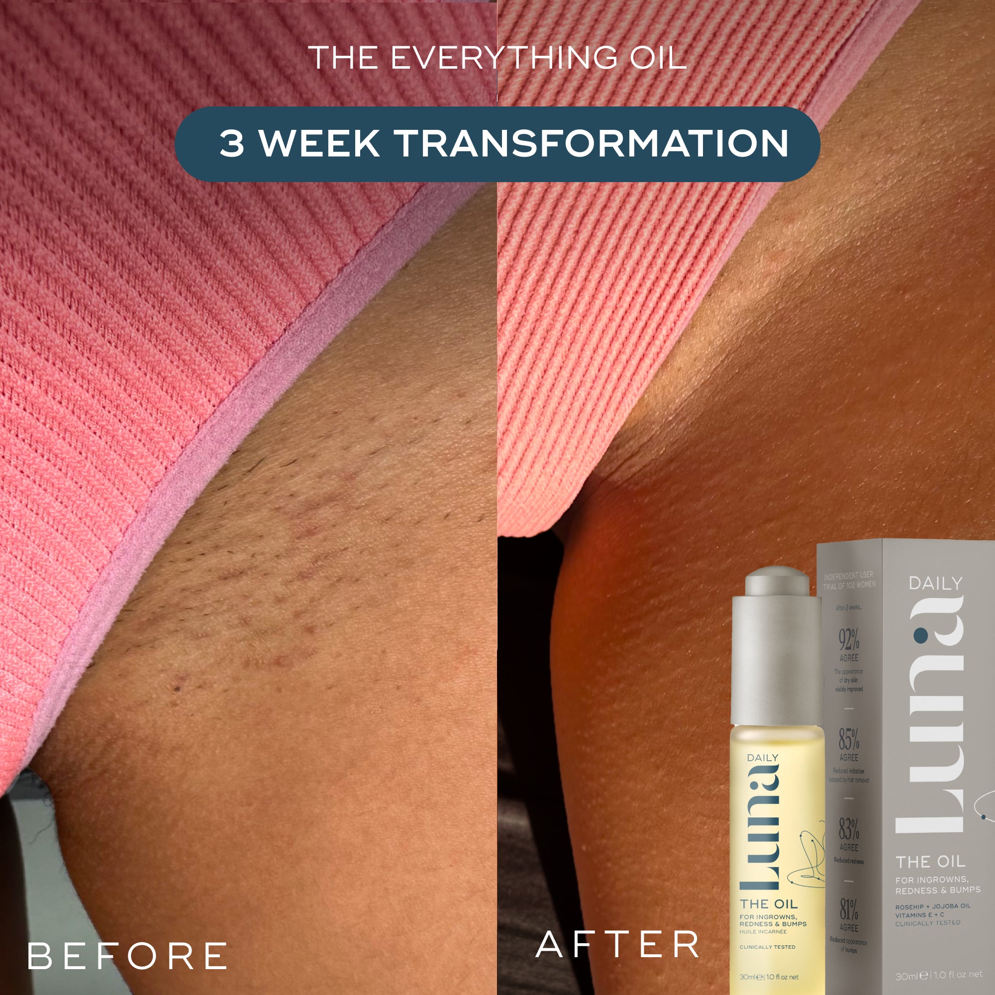 Smooth Skin Saviours - Rid Ingrowns, Redness + Bumps in 2 weeks (+FREE Lotion worth £20)